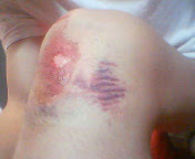 バイク事故 ひざ