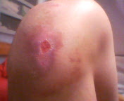 バイク事故 ひざ