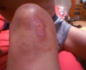 バイク事故 ひざ